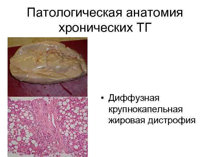 Патологическая анатомия хронических ТГ    • Диффузная   крупнокапельная  