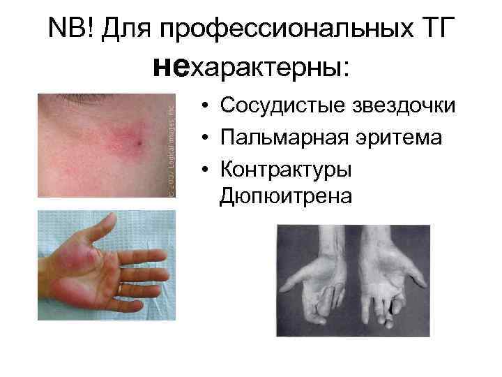 NB! Для профессиональных ТГ  нехарактерны:   • Сосудистые звездочки  • Пальмарная