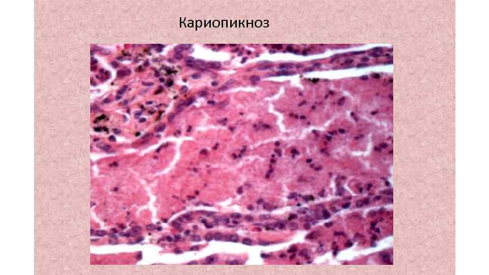 Кариопикноз 