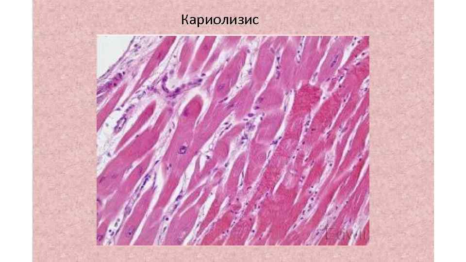 Кариолизис 