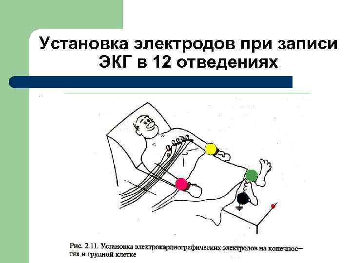 Техника снятия экг наложение электродов картинки