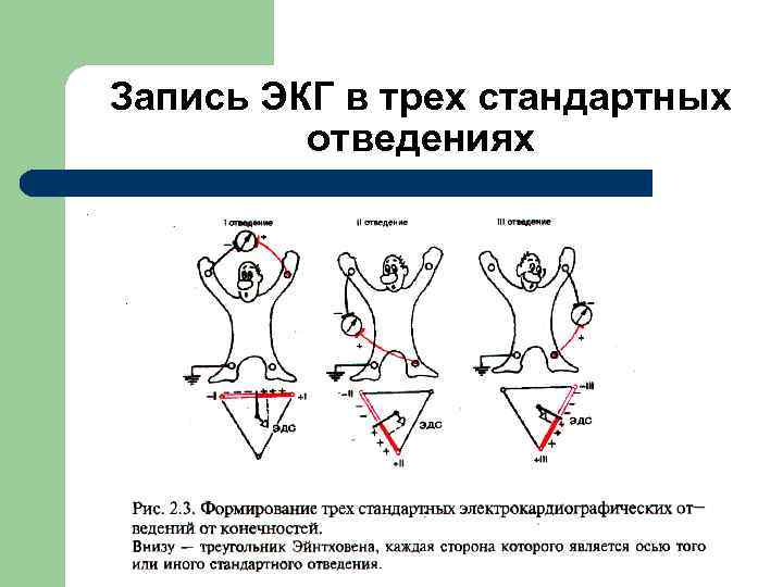 Низкоамплитудные отведения экг