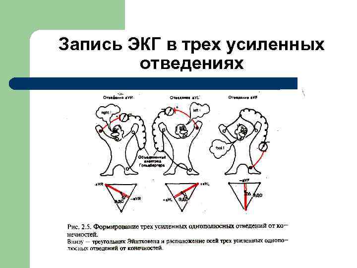 Запись ЭКГ в трех усиленных отведениях 