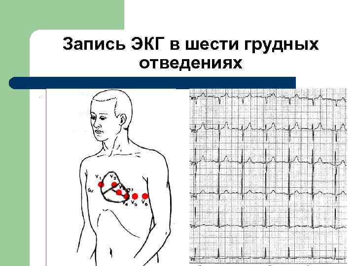 Экг грудные. Грудные отведения ЭКГ норма. Грудные отврдррия в норме ЭКГ. Правые грудные отведения на ЭКГ норма. Регистрация ЭКГ В грудных отведениях.