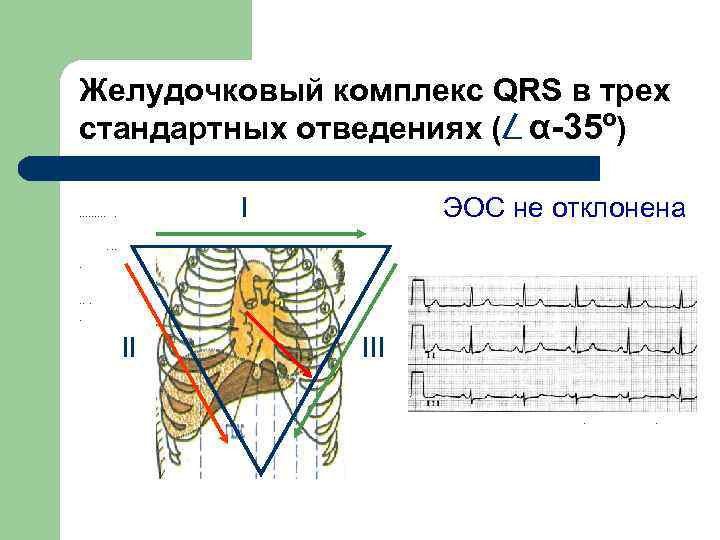 Желудочковый комплекс QRS в трех стандартных отведениях ( α-35º) ………. I ЭОС не отклонена