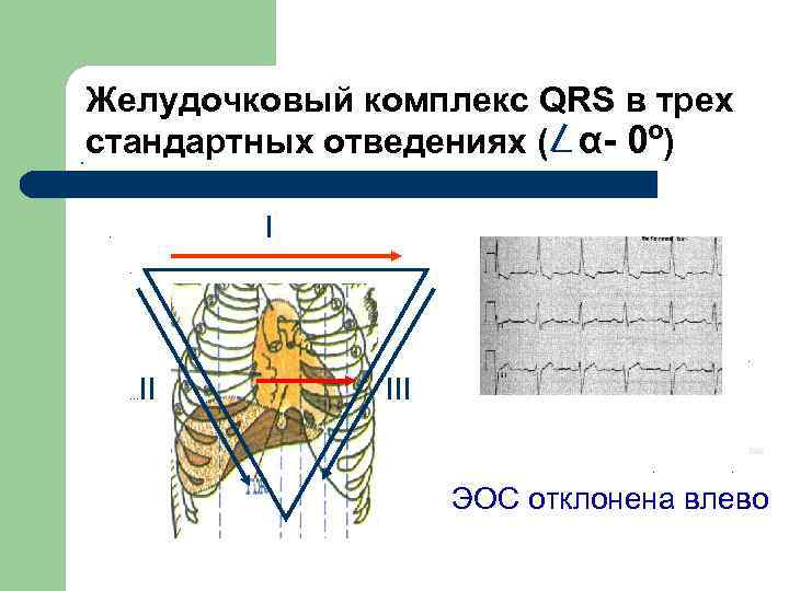  Желудочковый комплекс QRS в трех . стандартных отведениях ( α- 0º) I .