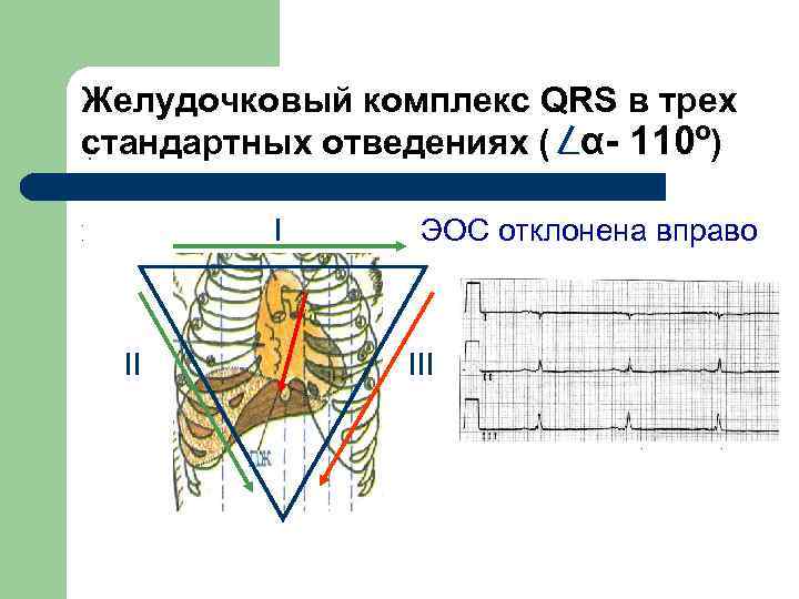 Желудочковый комплекс QRS в трех стандартных отведениях ( α- 110º) . . . I