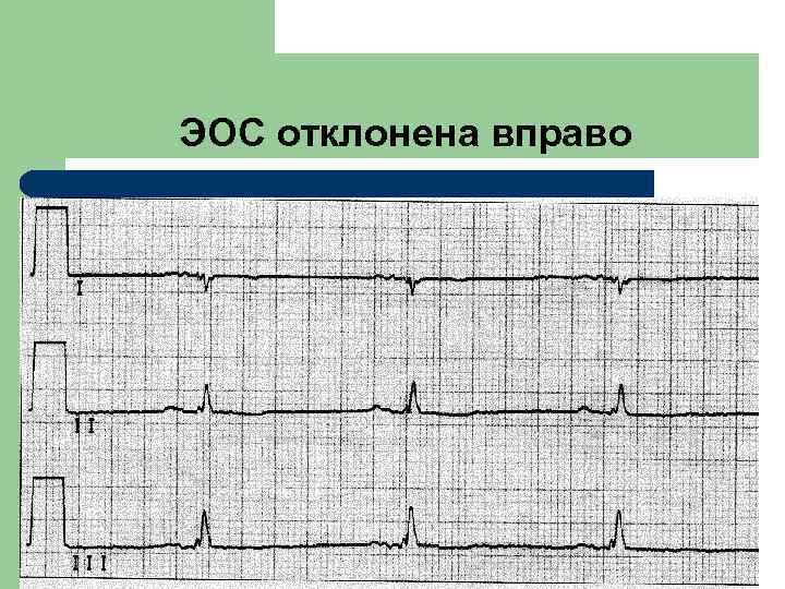 Отклонение эос влево