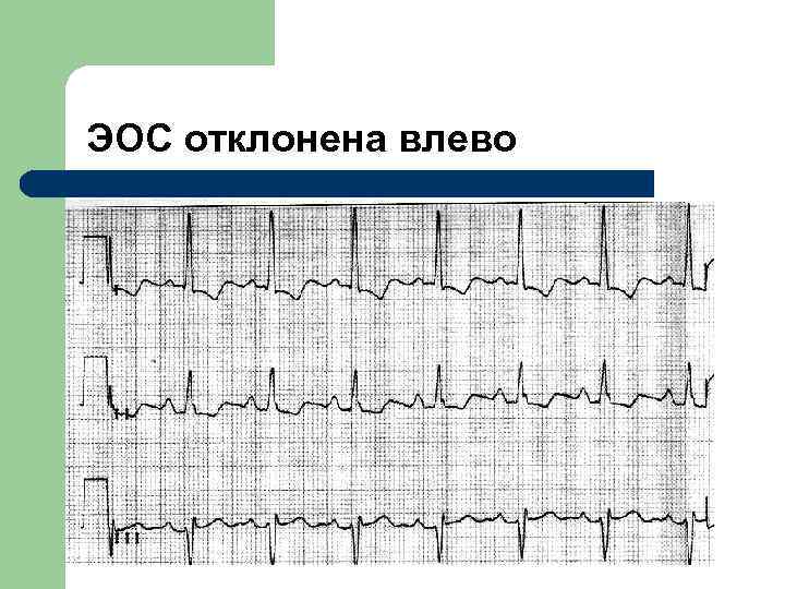 Электрическая ось сердца отклонена влево