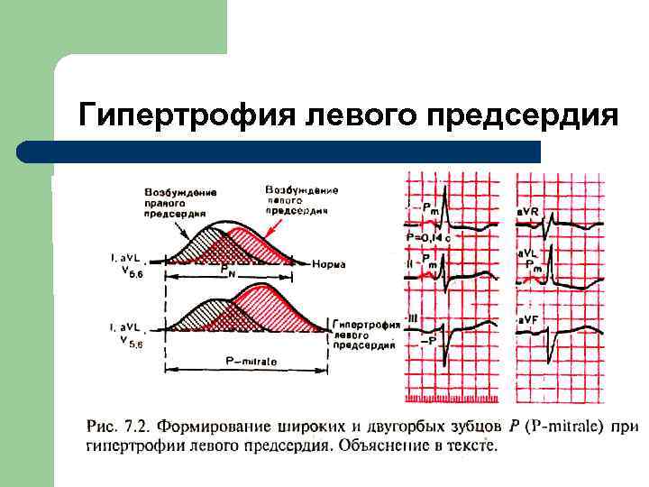 Гипертрофия левого предсердия 