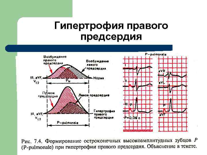  Гипертрофия правого предсердия. 