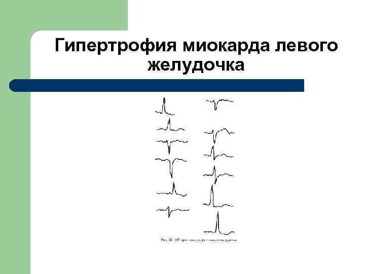 Гипертрофия миокарда левого желудочка 