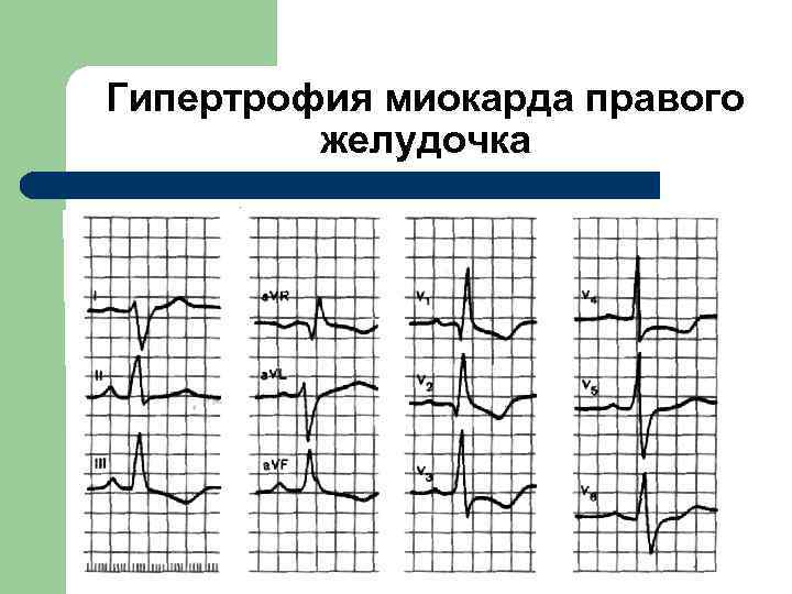  Гипертрофия миокарда правого желудочка. . 