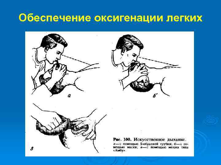 Обеспечение оксигенации легких 