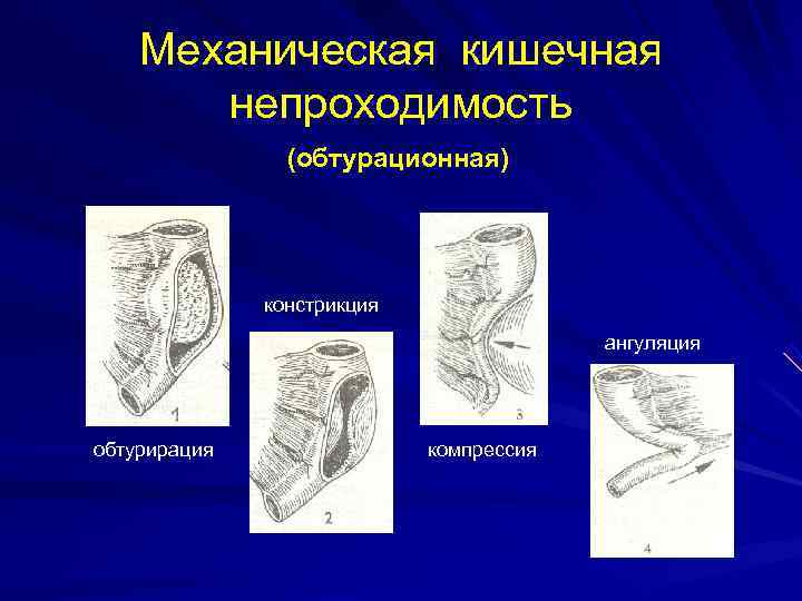  Механическая кишечная непроходимость (обтурационная) констрикция ангуляция обтурирация компрессия 