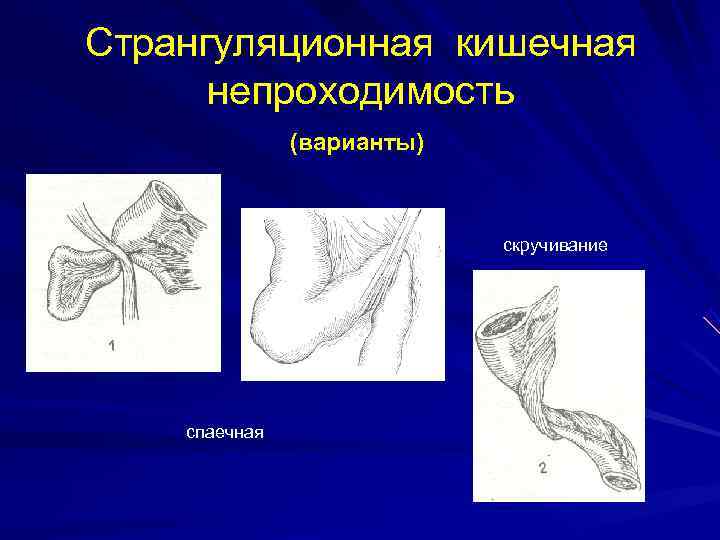 Странгуляционная кишечная непроходимость (варианты) скручивание спаечная 