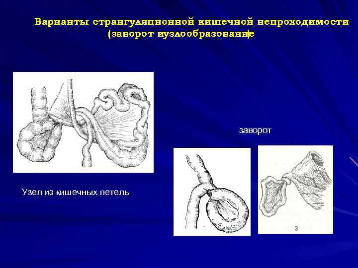  Варианты странгуляционной кишечной непроходимости (заворот иузлообразование ) заворот Узел из кишечных петель 