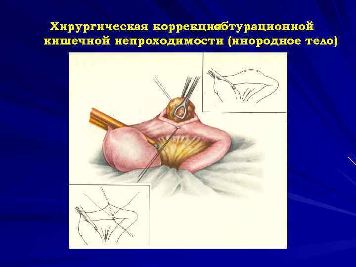  Хирургическая коррекция обтурационной кишечной непроходимости (инородное тело) 