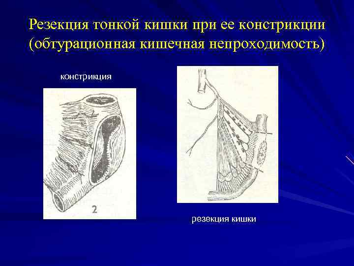 Резекция тонкой кишки при ее констрикции (обтурационная кишечная непроходимость) констрикция резекция кишки 