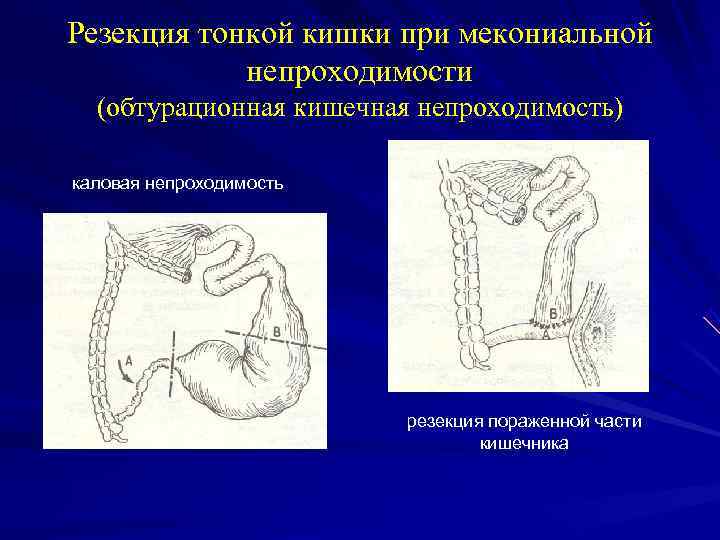 Резекция тонкой кишки при мекониальной непроходимости (обтурационная кишечная непроходимость) каловая непроходимость резекция пораженной части