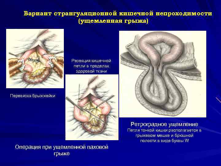  Вариант странгуляционной кишечной непроходимости (ущемленная грыжа) Резекция кишечной петли в пределах здоровой ткани