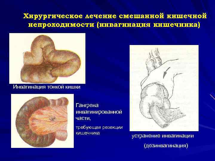  Хирургическое лечение смешанной кишечной непроходимости (инвагинация кишечника) Инвагинация тонкой кишки Гангрена инвагинированной части,