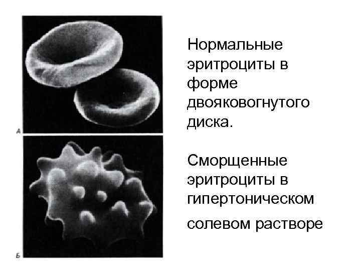 Нормальные эритроциты в форме двояковогнутого диска. Сморщенные эритроциты в гипертоническом солевом растворе 