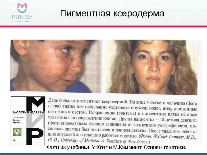   Пигментная ксеродерма Фото из учебника У. Клаг и М. Каммингс Основы генетики.