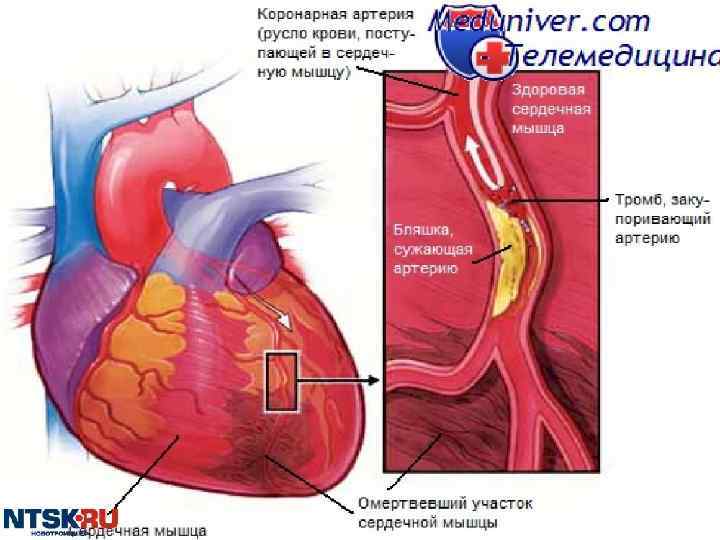 Инфаркт миокарда 