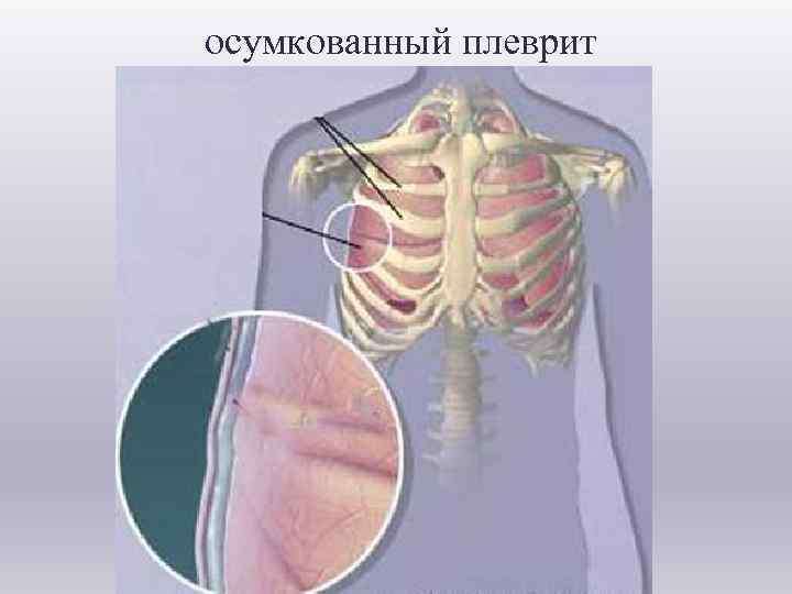  осумкованный плеврит 