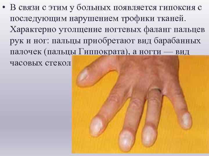  . • В связи с этим у больных появляется гипоксия с последующим нарушением