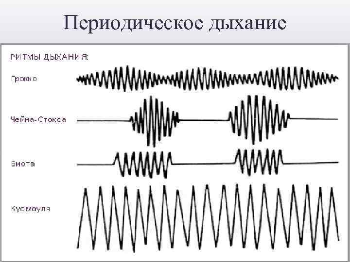 Периодическое дыхание 