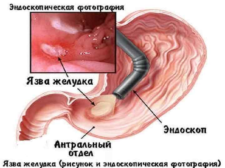  ЛАБОРАТОРНЫЕ И ИНСТРУМЕНТАЛЬНЫЕ МЕТОДЫ ИССЛЕДОВАНИЯ Фиброгастродуоденоскопия (ФГДС ) 