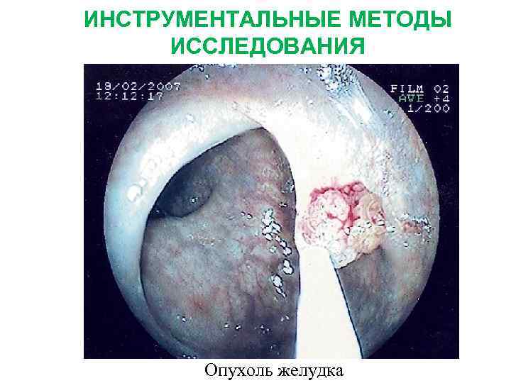 ИНСТРУМЕНТАЛЬНЫЕ МЕТОДЫ ИССЛЕДОВАНИЯ МНОЖЕСТВЕННЫЕ ПОЛИПЫ В ЖЕЛУДКЕ Опухоль желудка 