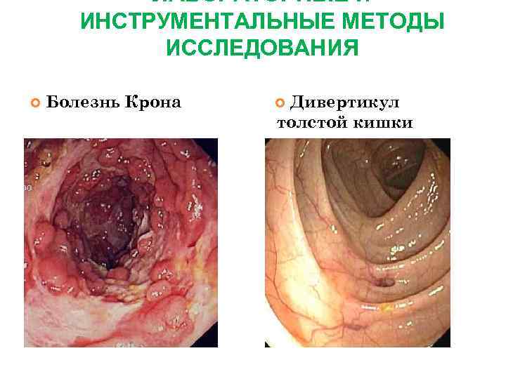  ЛАБОРАТОРНЫЕ И ИНСТРУМЕНТАЛЬНЫЕ МЕТОДЫ ИССЛЕДОВАНИЯ Болезнь Крона Дивертикул толстой кишки 