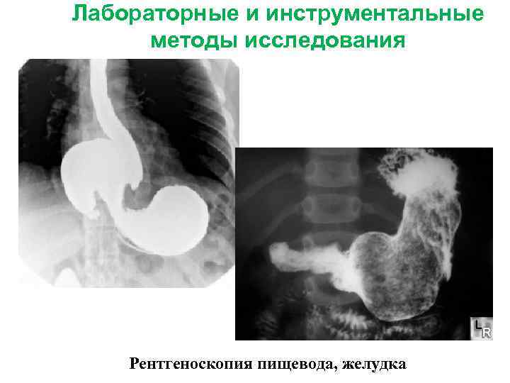 Лабораторные и инструментальные методы исследования Рентгеноскопия пищевода, желудка 