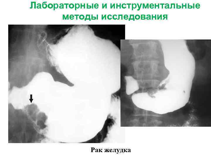 Лабораторные и инструментальные методы исследования Рак желудка 