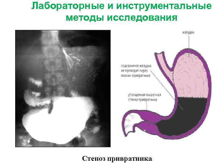 Лабораторные и инструментальные методы исследования Стеноз привратника 