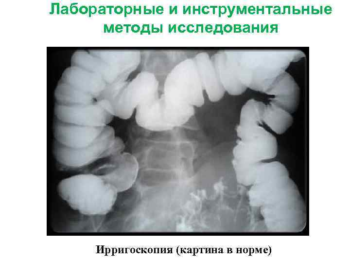 Лабораторные и инструментальные методы исследования Ирригоскопия (картина в норме) 