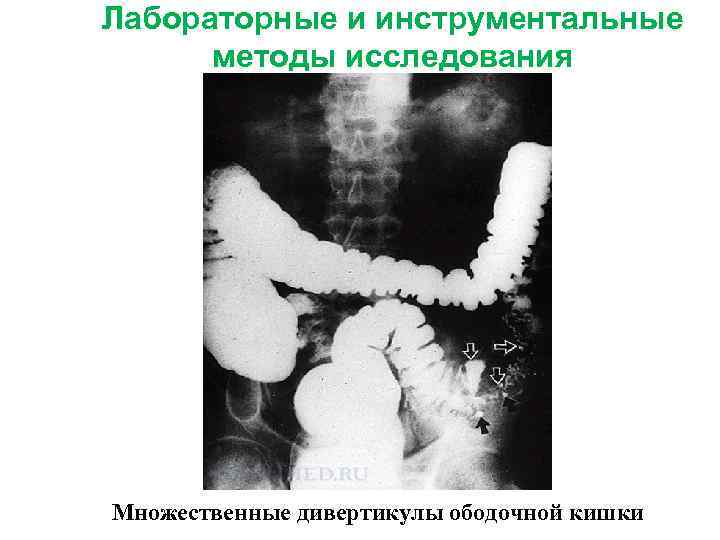 Лабораторные и инструментальные методы исследования Множественные дивертикулы ободочной кишки 