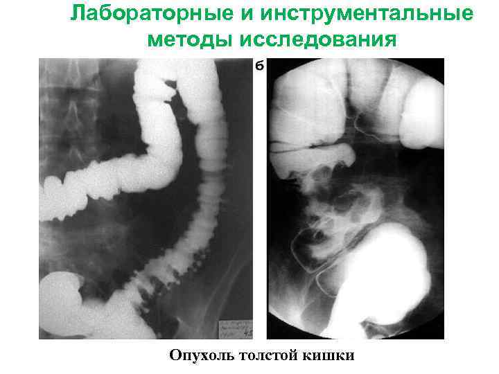 Лабораторные и инструментальные методы исследования Опухоль толстой кишки 