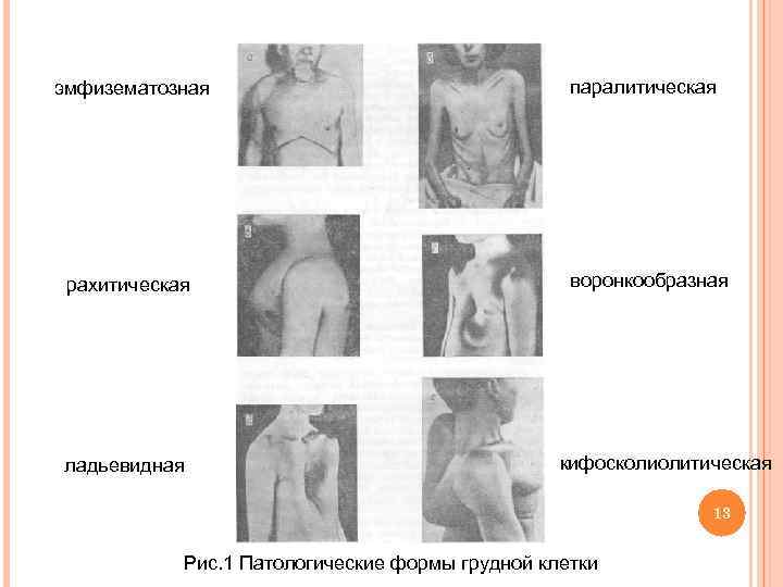 эмфизематозная паралитическая рахитическая воронкообразная ладьевидная кифосколиолитическая 13 Рис. 1 Патологические формы грудной клетки 