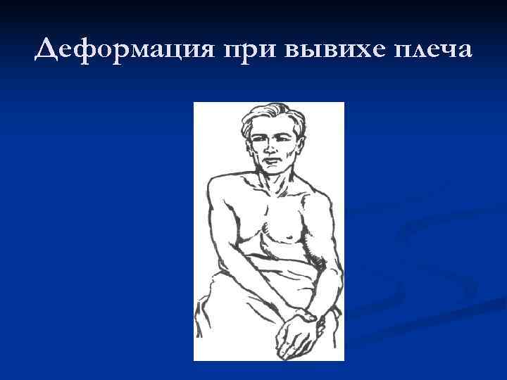 Деформация при вывихе плеча 