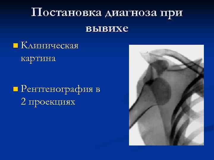  Постановка диагноза при вывихе n Клиническая картина n Рентгенография в 2 проекциях 