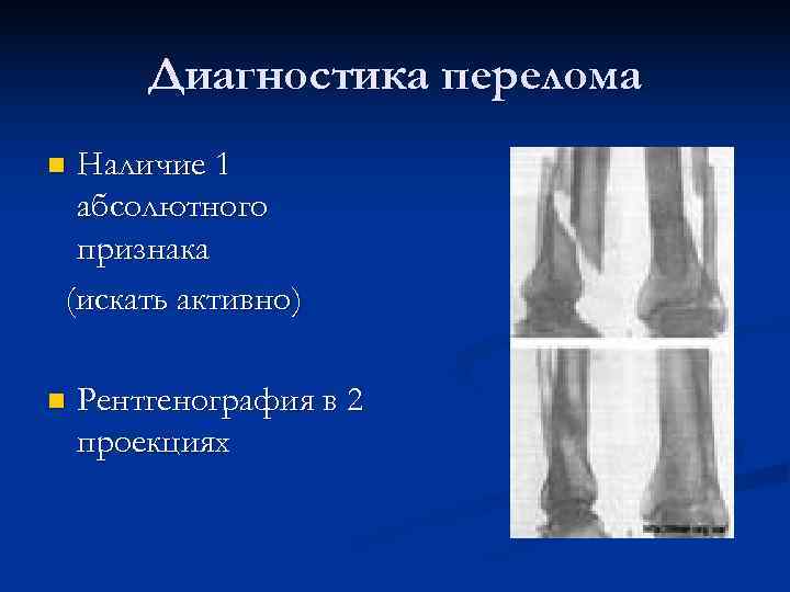  Диагностика перелома n. Наличие 1 абсолютного признака (искать активно) n Рентгенография в 2