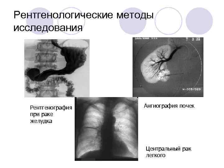 Рентгенологические методы исследования Рентгенография Ангиография почек при раке желудка Центральный рак легкого 