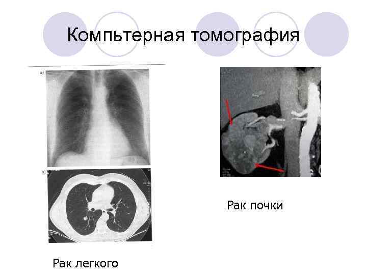  Компьтерная томография Рак почки Рак легкого 