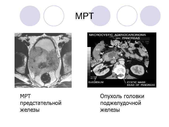  МРТ Опухоль головки предстательной поджелудочной железы 
