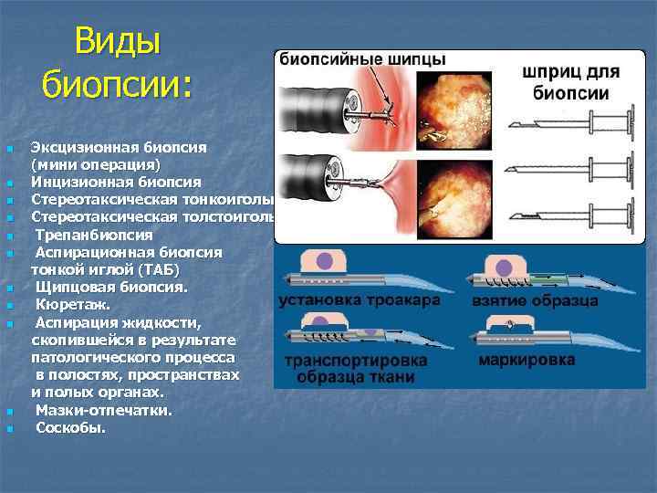  Виды биопсии: n Эксцизионная биопсия (мини операция) n Инцизионная биопсия n Стереотаксическая тонкоигольная