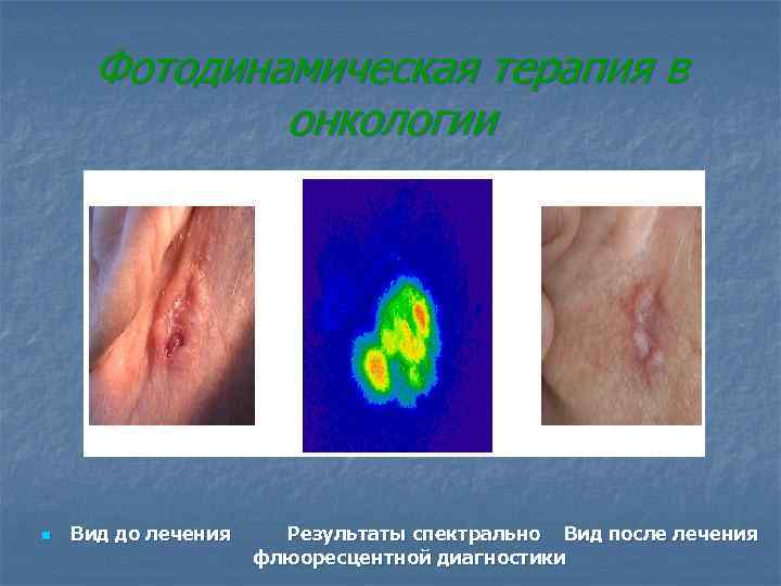  Фотодинамическая терапия в онкологии n Вид до лечения Результаты спектрально Вид после лечения